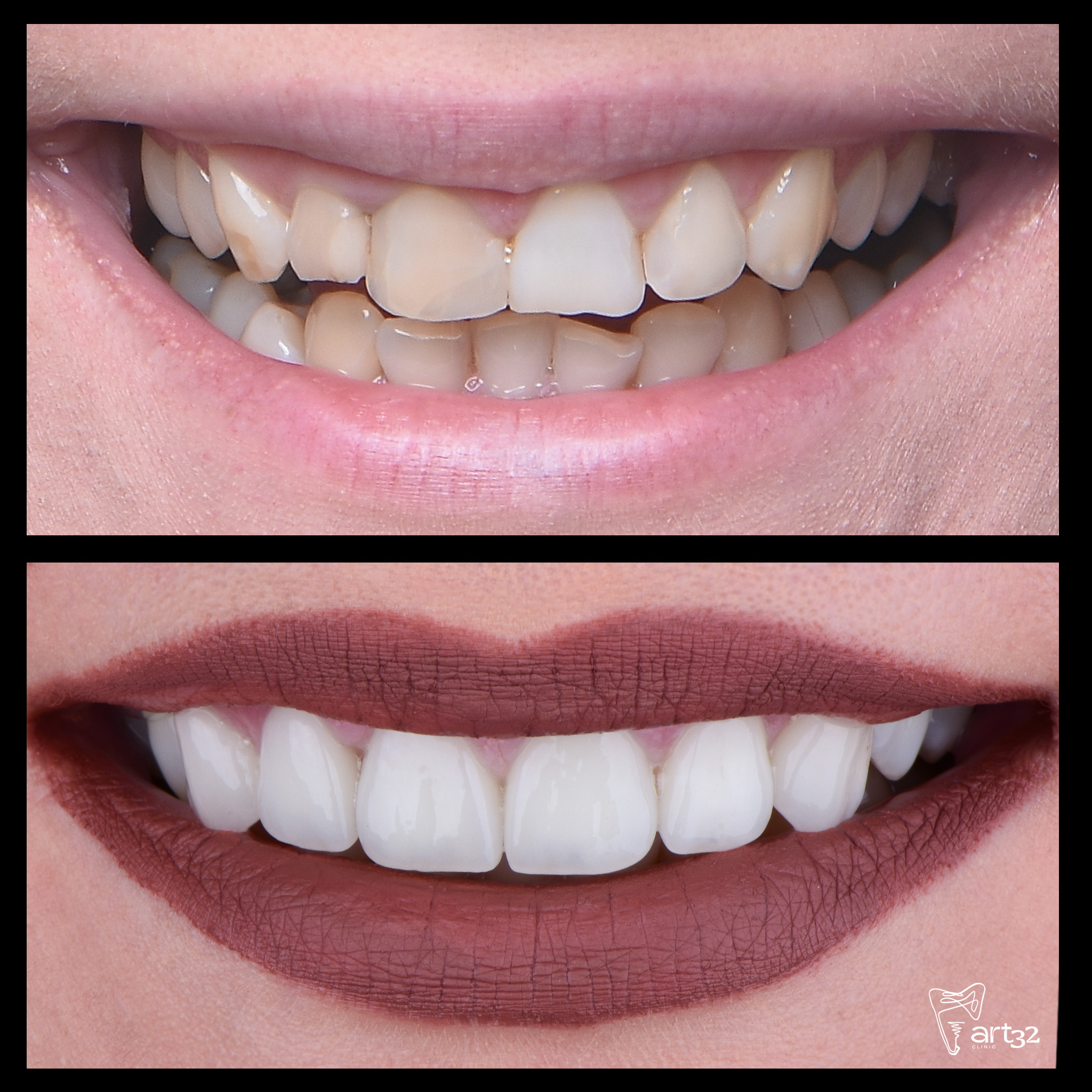 Conturare gingivală/aplicare de fațete