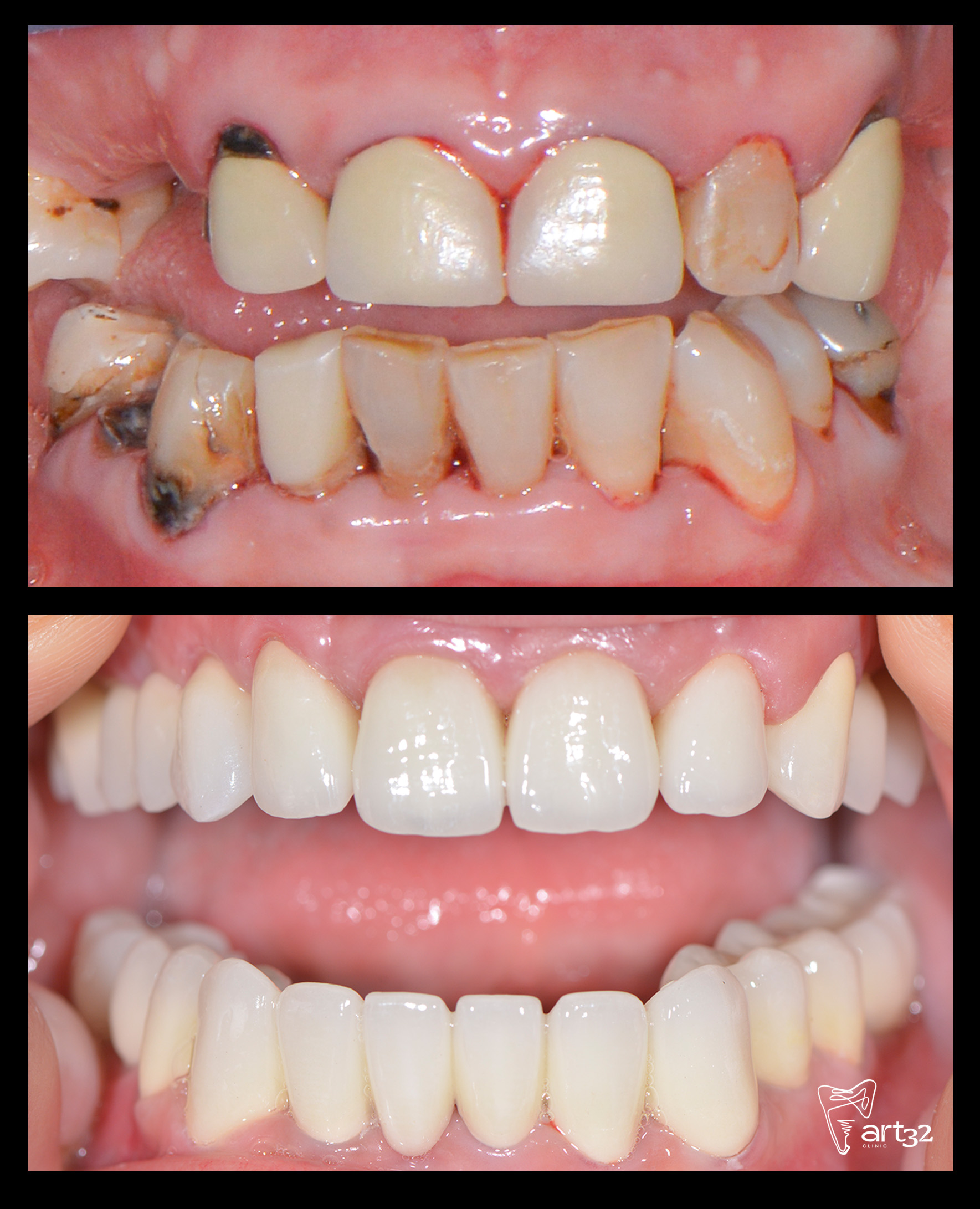 Reabilitare orală completă